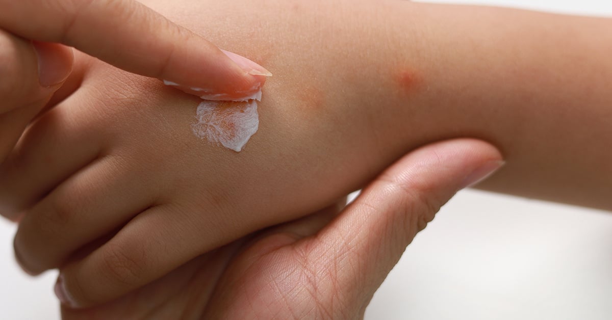 Une personne qui applique de la crème médicamenteuse sur une piqûre sur la main d'un enfant.